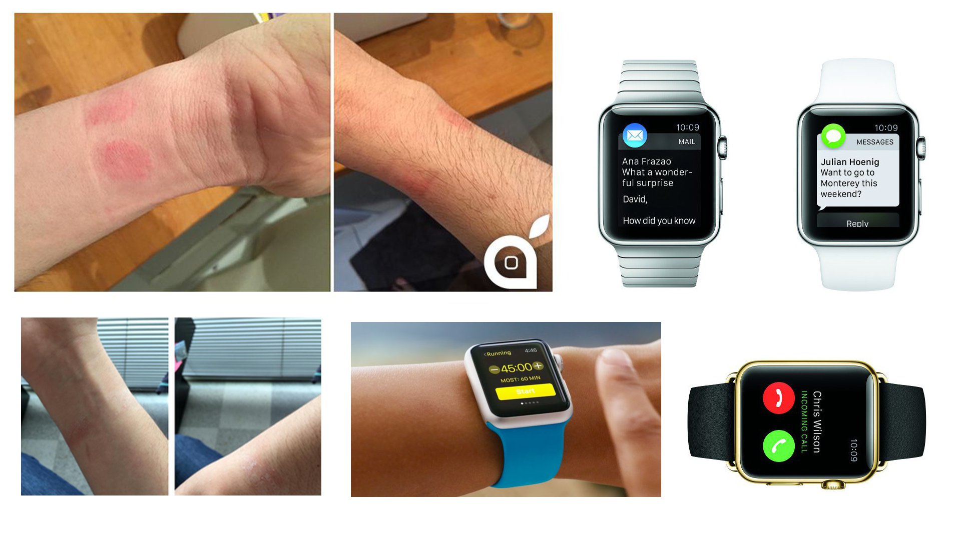 Apple Watch Causes Skin Irritation